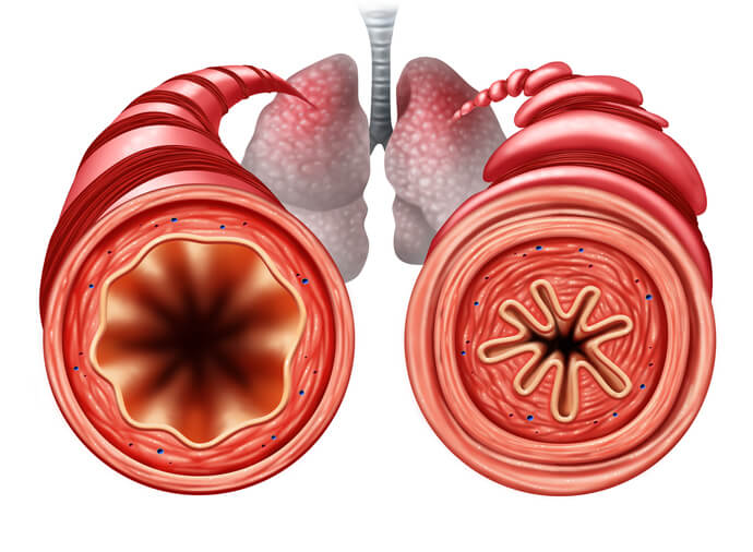 Icd Cm Code For Reactive Airway Disease